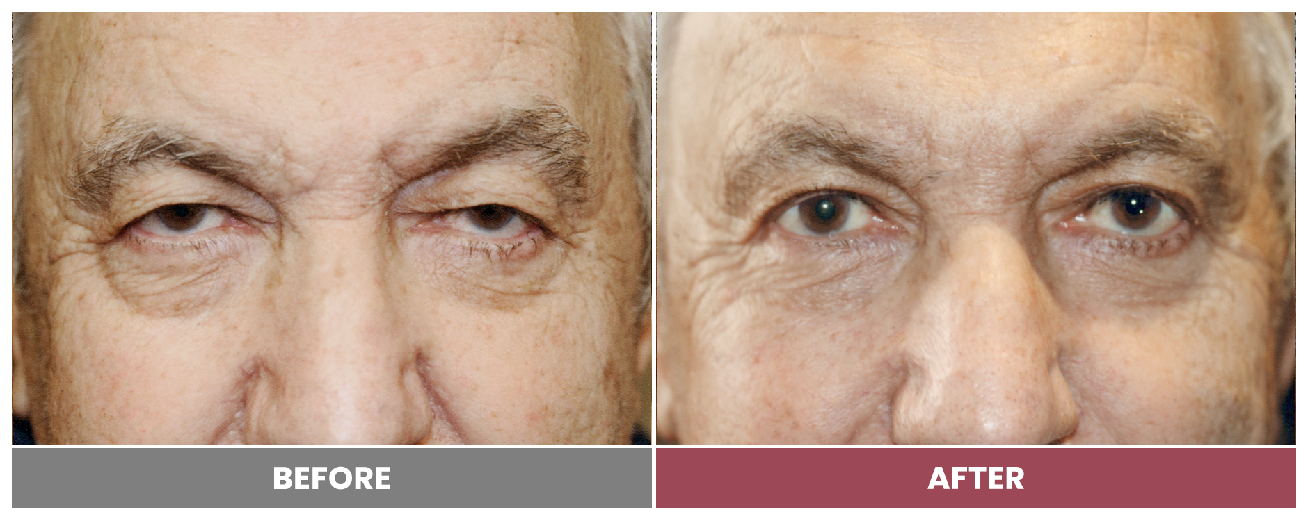 Upper Blepharoplasty - Case 103